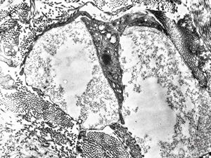 M, 40y. | reticular erythematous mucinosis M, 40y. | reticular erythematous mucinosis